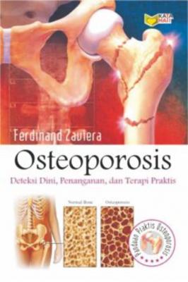 OSTEOPOROSIS :  Deteksi Dini, Penanganan, dan Terapi Praktis